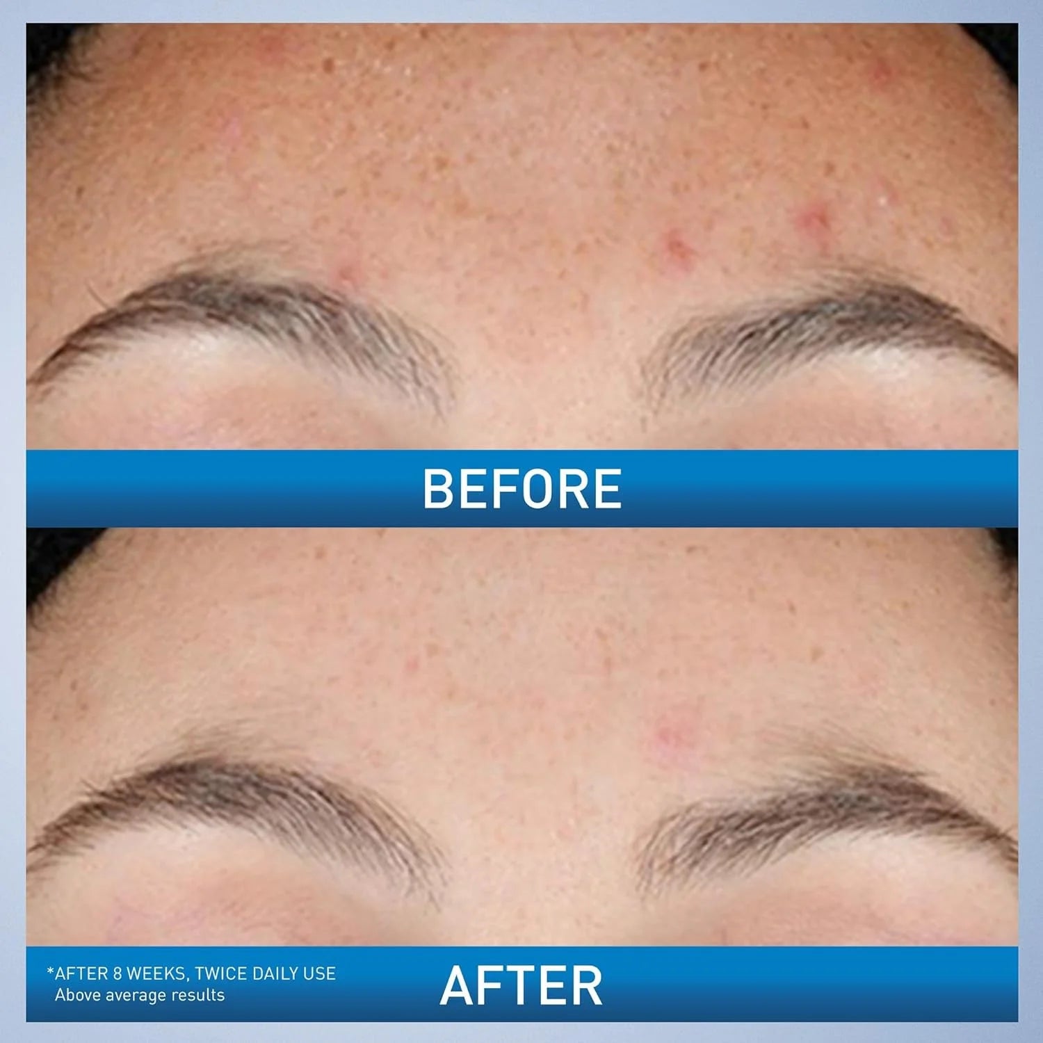 CeraVe Retinol Serum Niacinamida Raíz de Regaliz, Cuidado Tonal Suavizante de la Piel, Reparación de la Barrera, No Comedogénico Para Piel Propensa a Imperfecciones