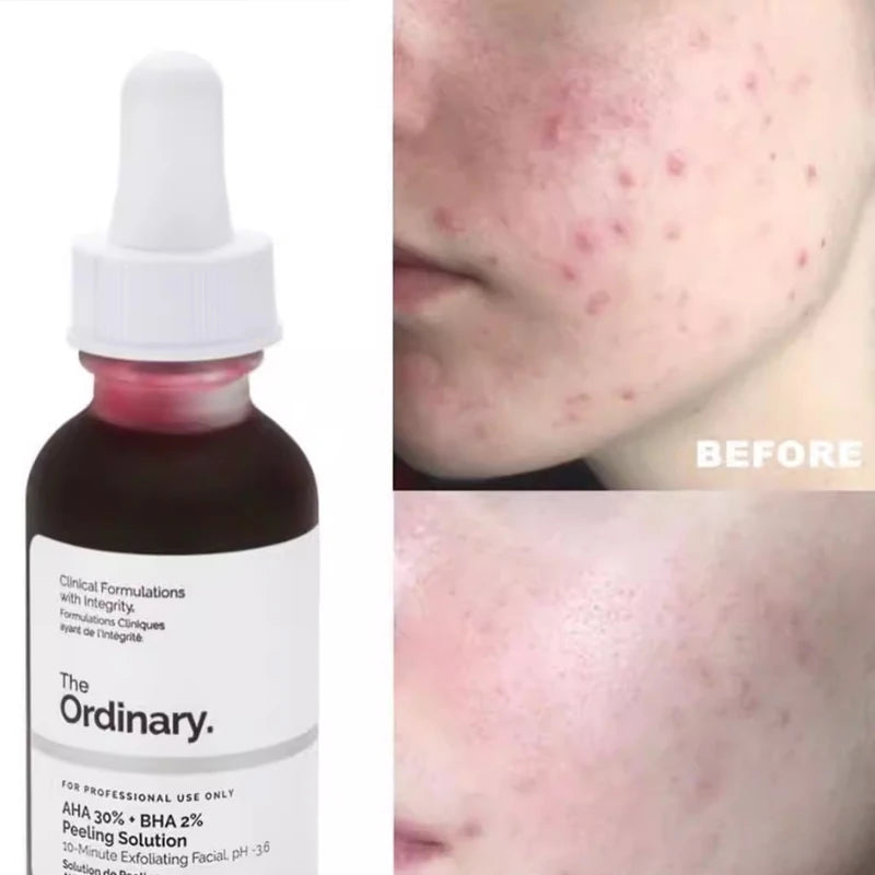 AHA 30% + BHA 2% Solución Peeling 30ml Solución Peeling Exfoliante Facial Ilumina Alisa Limpia Poros y Aclara la Opacidad